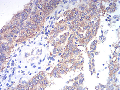 Fig5: Immunohistochemical analysis of paraffin-embedded human endometrial cancer tissue using anti-TBCC antibody. Counter stained with hematoxylin.