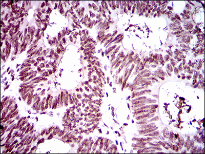 Immunohistochemical analysis of paraffin-embedded rectum cancer tissues using Ring1 mouse mAb with DAB staining.