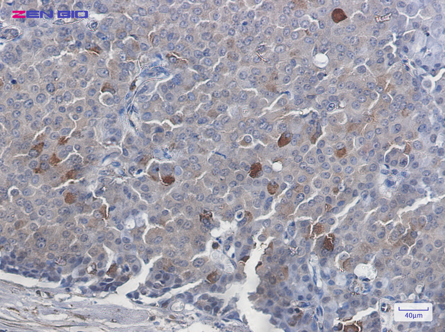 Immunohistochemistry of EGFR in paraffin-embedded Human breast cancer tissue using EGFR Rabbit pAb at dilution 1/20