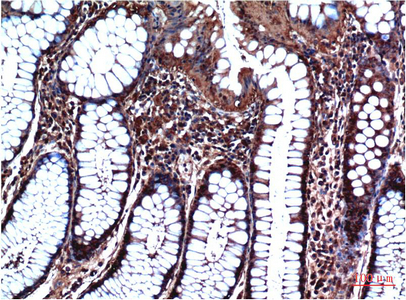 Immunohistochemical analysis of paraffin-embedded Human Stomach Carcinoma Tissue using GSK3β Mouse mAb diluted at 1:200.