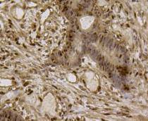 Fig5: Immunohistochemical analysis of paraffin- embedded human colon cancer tissue using anti-EFTUD2 Mouse mAb.