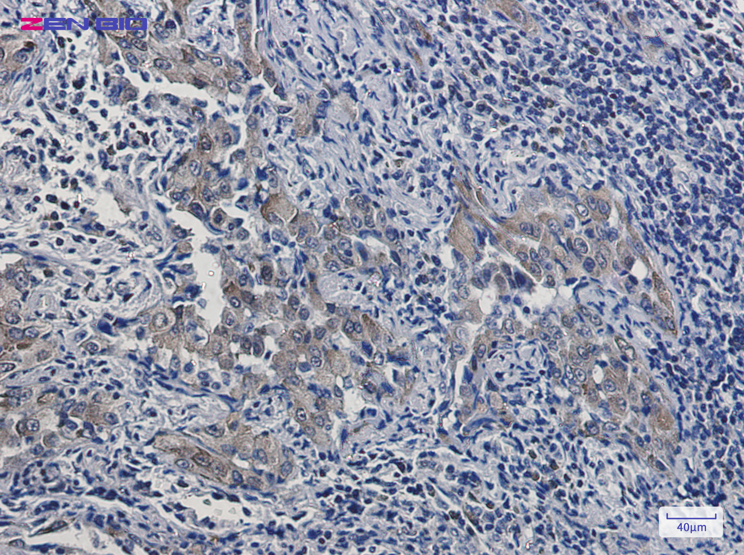 Immunohistochemistry of Artemin in paraffin-embedded Human lung cancer tissue using Artemin Rabbit pAb at dilution 1/20