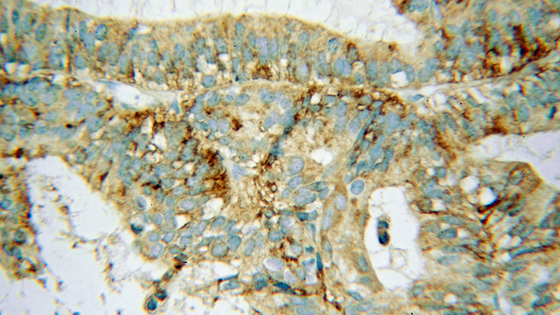 Immunohistochemical of paraffin-embedded human ovary tumor using Catalog No:108126(AP3S2 antibody) at dilution of 1:100 (under 40x lens)