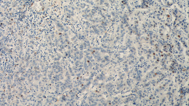 Immunohistochemistry of paraffin-embedded human prostate cancer tissue slide using Catalog No:116223(TPX2 Antibody) at dilution of 1:200 (under 10x lens). heat mediated antigen retrieved with Tris-EDTA buffer(pH9).