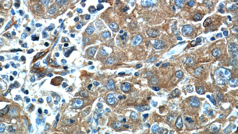 Immunohistochemistry of paraffin-embedded human liver cancer tissue slide using Catalog No:113221(C5orf23 Antibody) at dilution of 1:50 (under 40x lens)