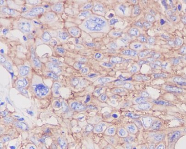 Immunohistochemical analysis of paraffin-embedded human cervix cancer, using GLUT1 Antibody.