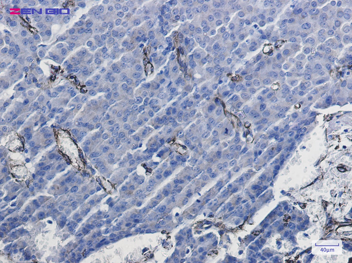 Immunohistochemistry of Caveolin-1 in paraffin-embedded Human breast cancer tissue using Caveolin-1 Rabbit pAb at dilution 1/20