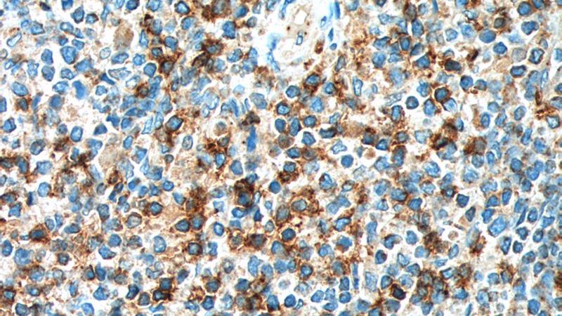 Immunohistochemistry of paraffin-embedded human tonsillitis tissue slide using Catalog No:109145(CD8A Antibody) at dilution of 1:200 (under 40x lens). heat mediated antigen retrieved with Tris-EDTA buffer(pH9).