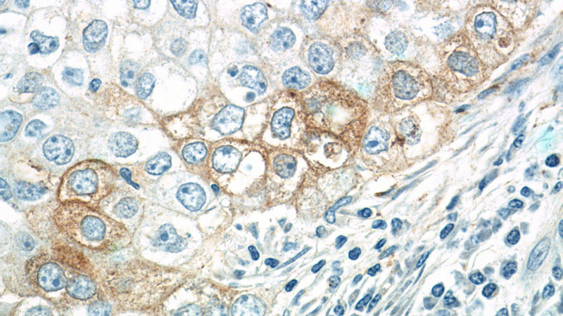 Immunohistochemistry of paraffin-embedded human breast cancer tissue slide using Catalog No:110402(ERBB3 Antibody) at dilution of 1:200 (under 40x lens)