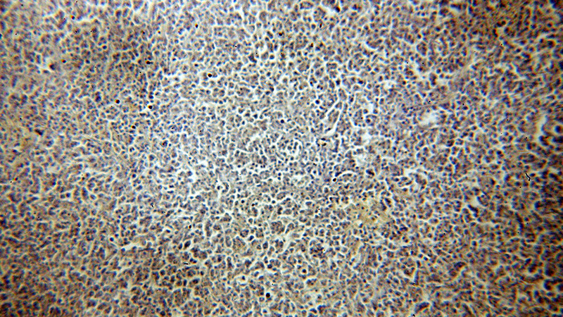 Immunohistochemical of paraffin-embedded human lymphoma using Catalog No:112351(LSM7 antibody) at dilution of 1:50 (under 10x lens)