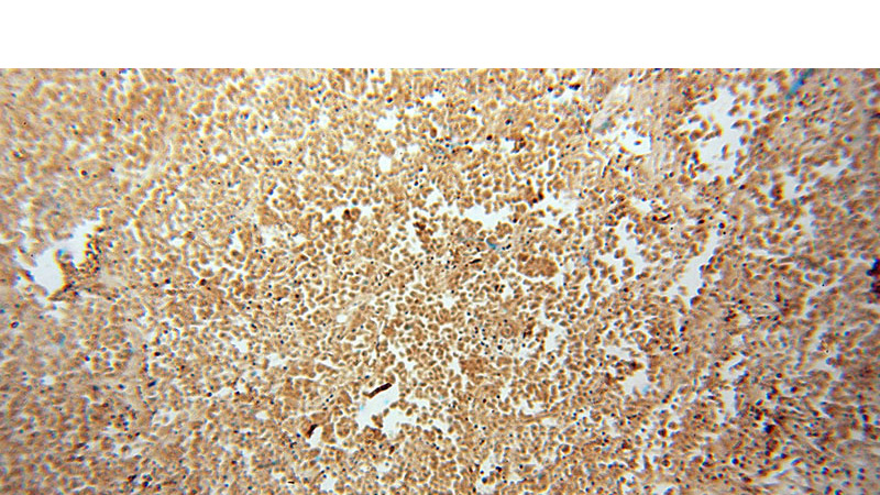 Immunohistochemical of paraffin-embedded human lung cancer using Catalog No:114380(PSMB10 antibody) at dilution of 1:50 (under 10x lens)