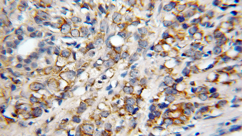 Immunohistochemical of paraffin-embedded human prostate cancer using Catalog No:114639(RGR antibody) at dilution of 1:100 (under 10x lens)