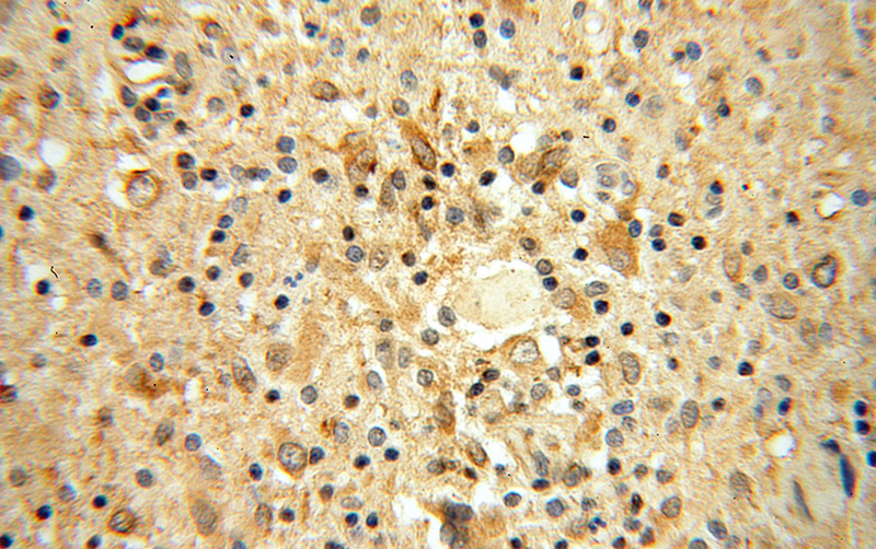 Immunohistochemical of paraffin-embedded human gliomas using Catalog No:111880(JAKMIP1 antibody) at dilution of 1:100 (under 40x lens)