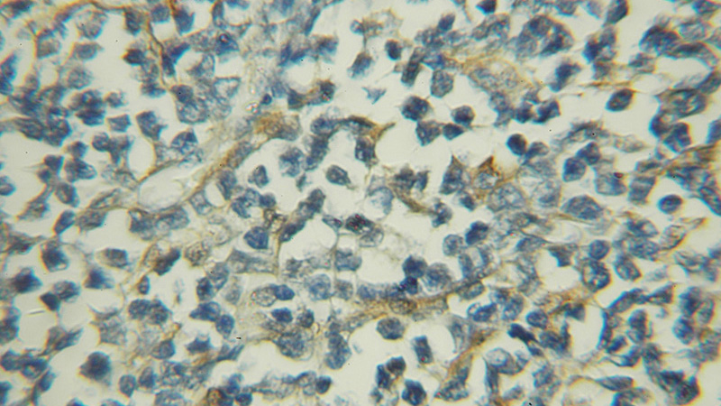 Immunohistochemical of paraffin-embedded human lymphoma using Catalog No:111498(HNMT antibody) at dilution of 1:50 (under 10x lens)