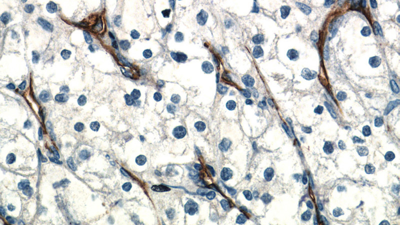 Immunohistochemistry of paraffin-embedded human renal cell carcinoma tissue slide using Catalog No:109025(CD31 Antibody) at dilution of 1:400 (under 40x lens)
