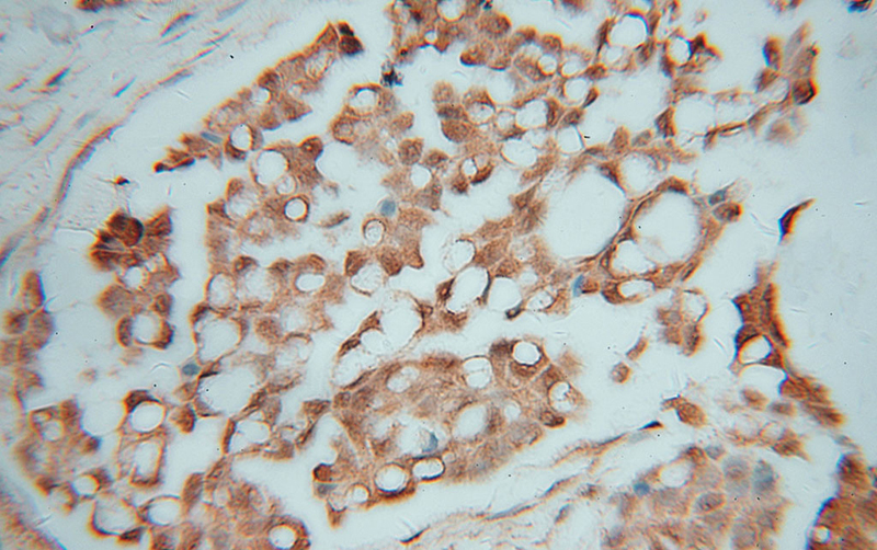 Immunohistochemical of paraffin-embedded human ovary tumor using Catalog No:114389(PSMC2 antibody) at dilution of 1:100 (under 40x lens)