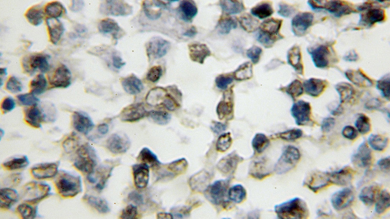 Immunohistochemical of paraffin-embedded human lymphoma using Catalog No:110000(DLX4 antibody) at dilution of 1:50 (under 10x lens)