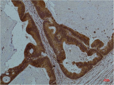 Immunohistochemical analysis of paraffin-embedded Human Colon Caricnoma using STAT3Mouse mAb diluted at 1:200.