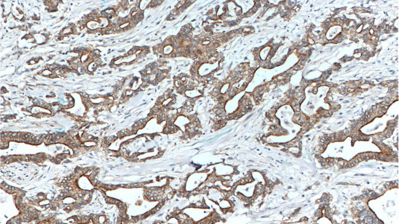 Immunohistochemistry of paraffin-embedded human pancreas cancer tissue slide using Catalog No:111654(IL10 Antibody) at dilution of 1:200 (under 10x lens). heat mediated antigen retrieved with Tris-EDTA buffer(pH9).