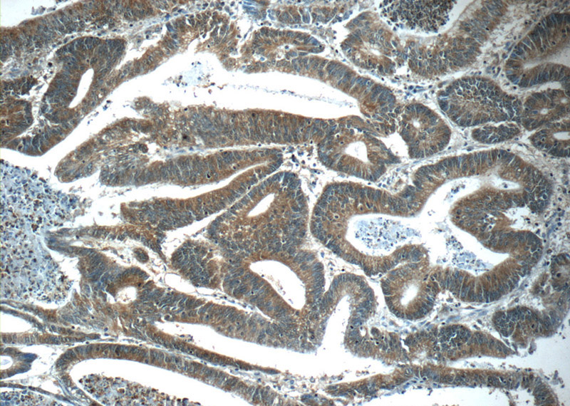 Immunohistochemistry of paraffin-embedded human colon cancer tissue slide using Catalog No:108795(C8orf77 Antibody) at dilution of 1:50 (under 10x lens)