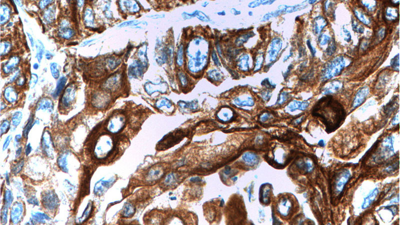 Immunohistochemistry of paraffin-embedded human lung cancer tissue slide using Catalog No:109807(KRT6A Antibody) at dilution of 1:200 (under 40x lens).