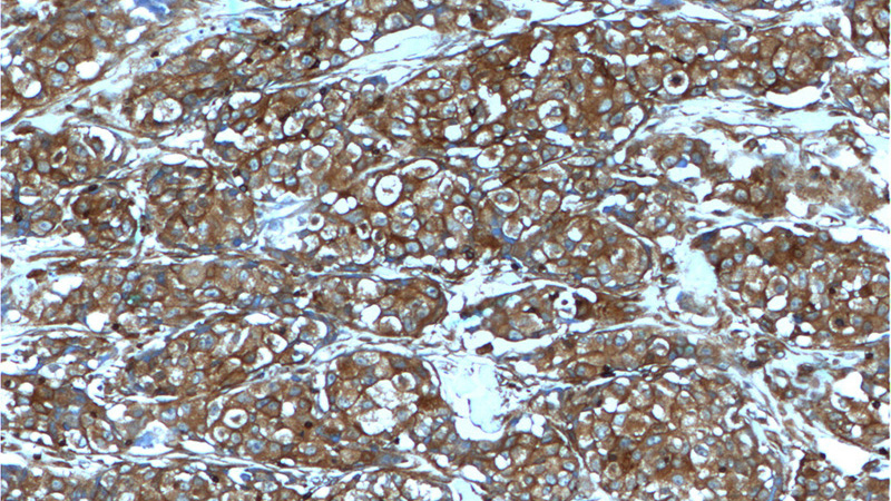Immunohistochemistry of paraffin-embedded human lung cancer tissue slide using Catalog No:111678(IGF1R-Specific Antibody) at dilution of 1:200 (under 10x lens).