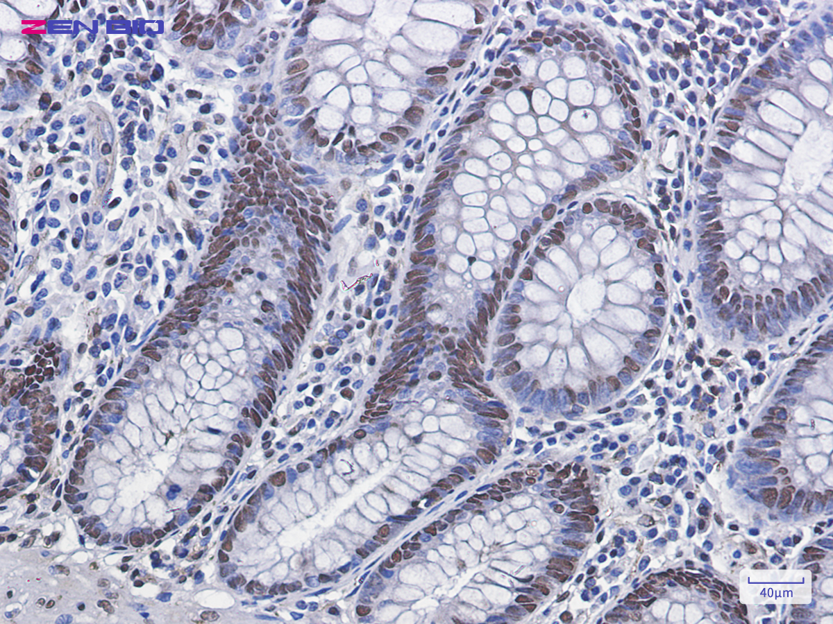 Immunohistochemistry of Phospho-MDM2 (Ser166) in paraffin-embedded human colon cancer tissue using Phospho-MDM2 (Ser166) Rabbit mAb at dilution 1/100