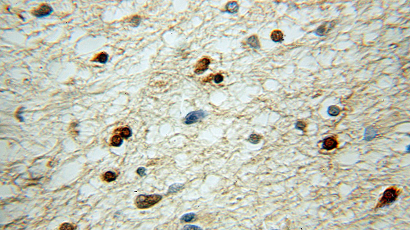 Immunohistochemical of paraffin-embedded human gliomas using Catalog No:115698(STMN1 antibody) at dilution of 1:50 (under 10x lens)