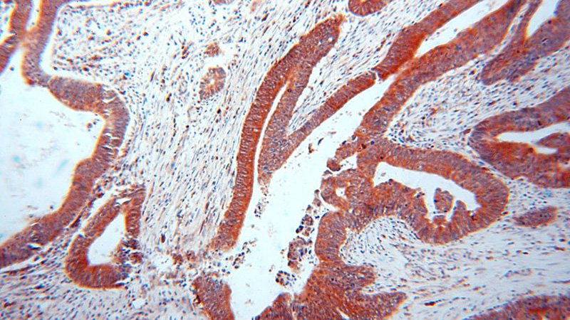 Immunohistochemical of paraffin-embedded human colon cancer using Catalog No:115253(SKAP2 antibody) at dilution of 1:100 (under 10x lens)