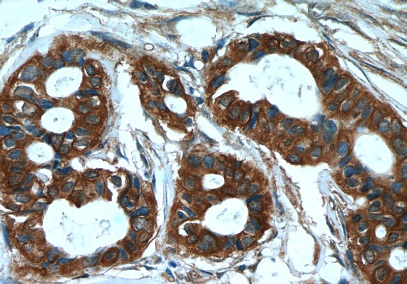 Immunohistochemistry of paraffin-embedded human breast cancer tissue slide using Catalog No:109809(KRT7 Antibody) at dilution of 1:50 (under 40x lens)