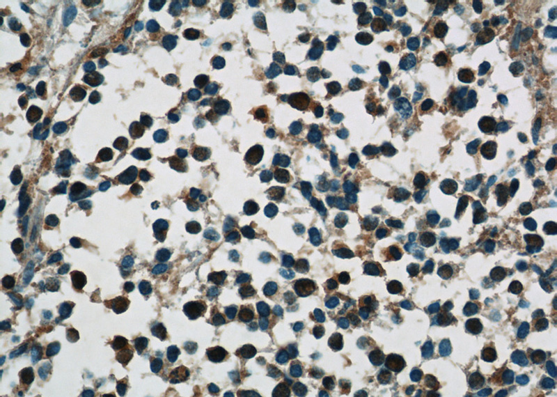 Immunohistochemistry of paraffin-embedded human lung cancer tissue slide using Catalog No:111718(ELAVL3 Antibody) at dilution of 1:50 (under 40x lens)