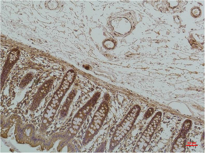 Immunohistochemical analysis of paraffin-embedded Human Colon Caricnoma using GRP78/BipMouse mAb diluted at 1:200.