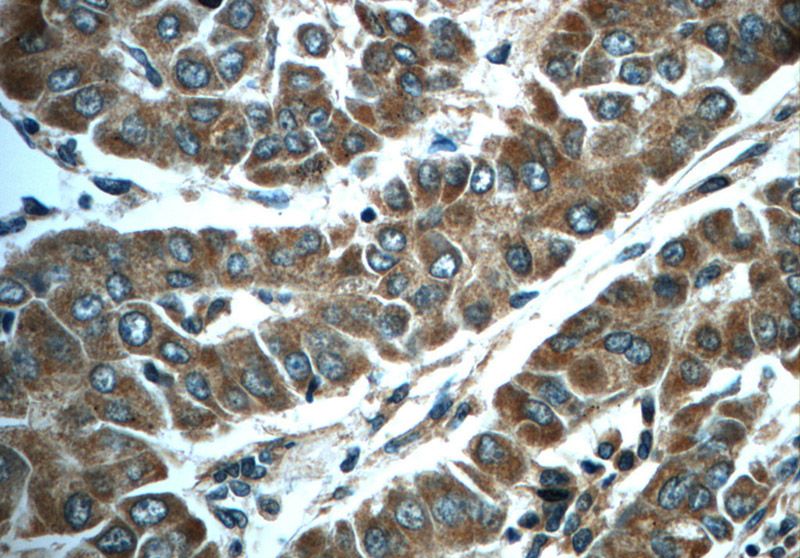 Immunohistochemistry of paraffin-embedded human liver cancer slide using Catalog No:111456(HPSE Antibody) at dilution of 1:50