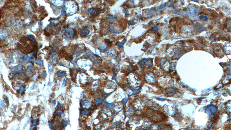 Immunohistochemistry of paraffin-embedded human breast cancer tissue slide using Catalog No:114961(S100A4 Antibody) at dilution of 1:200 (under 40x lens).