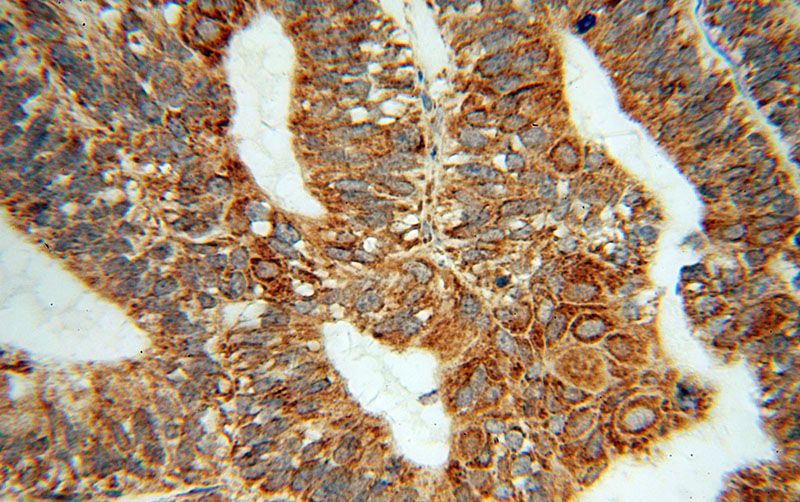 Immunohistochemical of paraffin-embedded human ovary tumor using Catalog No:112201(LETM1 antibody) at dilution of 1:100 (under 40x lens)