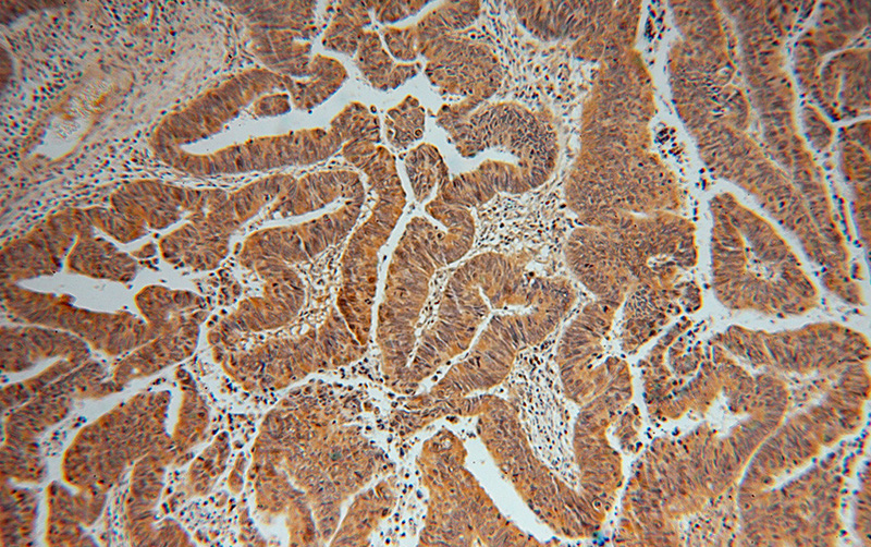 Immunohistochemical of paraffin-embedded human colon cancer using Catalog No:107793(ADI1 antibody) at dilution of 1:100 (under 10x lens)