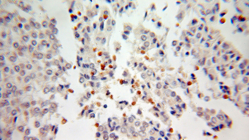 Immunohistochemical of paraffin-embedded human ovary tumor using Catalog No:114576(SNHG3-RCC1 antibody) at dilution of 1:100 (under 10x lens)