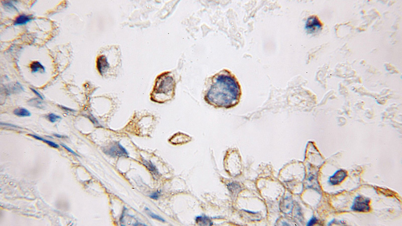 Immunohistochemical of paraffin-embedded human ovary tumor using Catalog No:111217(CXCL1 antibody) at dilution of 1:100 (under 10x lens)
