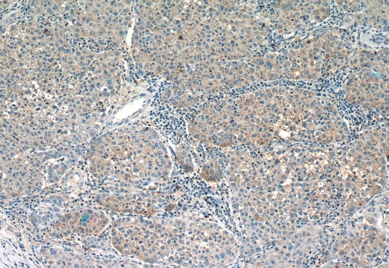 Immunohistochemistry of paraffin-embedded human liver cancer slide using Catalog No:108736(C5orf26 Antibody) at dilution of 1:50 (under 10x lens)