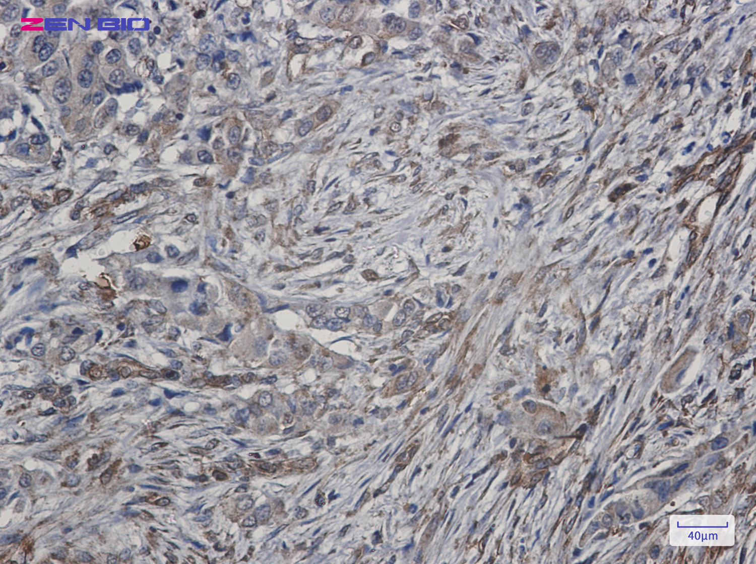Immunohistochemistry of ATG4C in paraffin-embedded Human lung cancer tissue using ATG4C Rabbit pAb at dilution 1/50