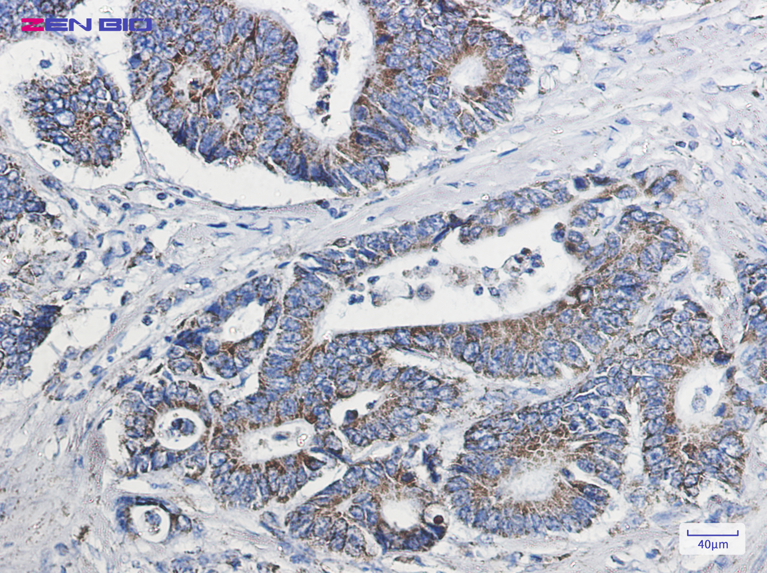 Immunohistochemistry of NDUFB10 in paraffin-embedded Human colon cancer tissue using NDUFB10 Rabbit pAb at dilution 1/50