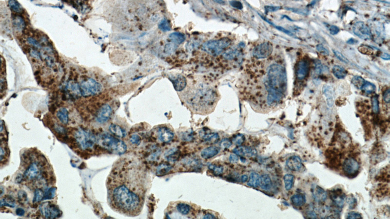 Immunohistochemical of paraffin-embedded human lung cancer using Catalog No:111799(INHBA antibody) at dilution of 1:50 (under 40x lens)