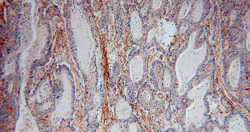 Immunohistochemical of paraffin-embedded human colon cancer using Catalog No:111589(ICAM-1 antibody) at dilution of 1:50 (under 10x lens)
