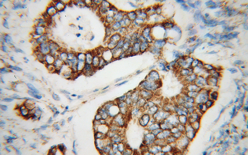 Immunohistochemical of paraffin-embedded human colon cancer using Catalog No:116636(UQCRC2 antibody) at dilution of 1:100 (under 40x lens)