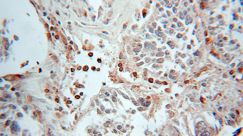 Immunohistochemical of paraffin-embedded human ovary tumor using Catalog No:110800(ATG8L antibody) at dilution of 1:50 (under 10x lens)
