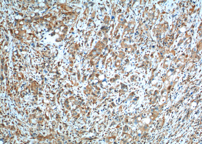 Immunohistochemistry of paraffin-embedded human liver cancer tissue slide using Catalog No:107304(GOT1 Antibody) at dilution of 1:200 (under 10x lens). heat mediated antigen retrieved with Tris-EDTA buffer(pH9).