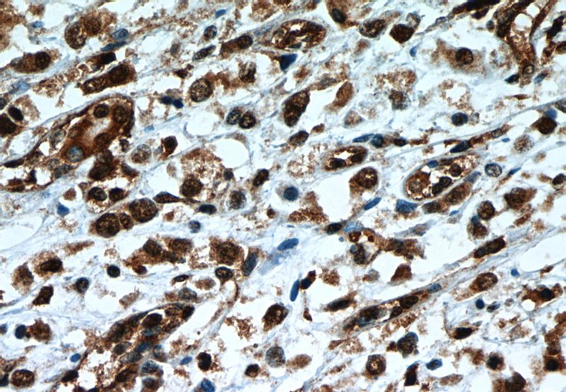 Immunohistochemistry of paraffin-embedded human breast cancer slide using Catalog No:107626(TLE3 Antibody) at dilution of 1:50