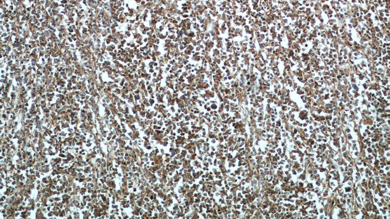 Immunohistochemical of paraffin-embedded human lymphoma using Catalog No:109125(CD45 antibody) at dilution of 1:50 (under 10x lens)