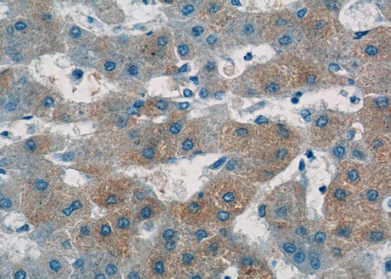 Immunohistochemistry of paraffin-embedded human hepatocirrhosis tissue slide using Catalog No:108036(APOA2 Antibody) at dilution of 1:50 (under 40x lens)