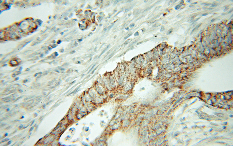 Immunohistochemical of paraffin-embedded human colon cancer using Catalog No:113108(NELF antibody) at dilution of 1:100 (under 10x lens)